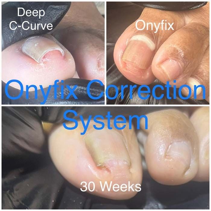 Onyfix toenail correction system before-and-after photos