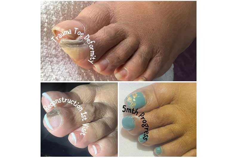 Nail restoration and correction service in Stockbridge, GA